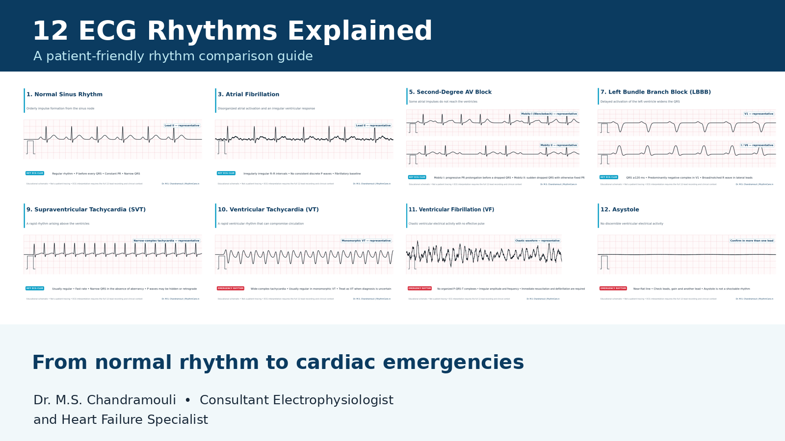 ECG Rhythm Comparison Cover – ECG Rhythm Comparison: 12 Heart Rhythms Explained