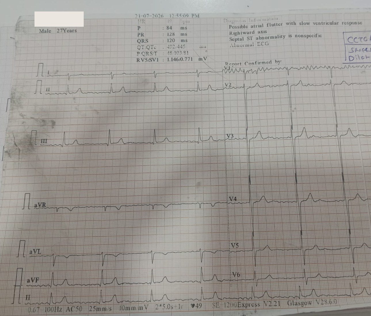 Baseline 12-lead ECG in CCTGA: atrial arrhythmia with slow ventricular response, rate 49/min, QRS 120 ms