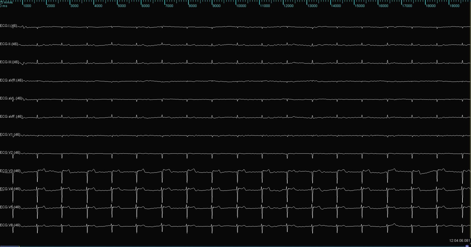 Baseline surface ECG on the EP recording system before the procedure: slow narrow-complex rhythm