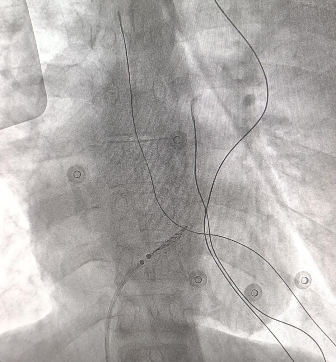 Fluoroscopy with the high-density mapping catheter positioned at the His bundle region in CCTGA