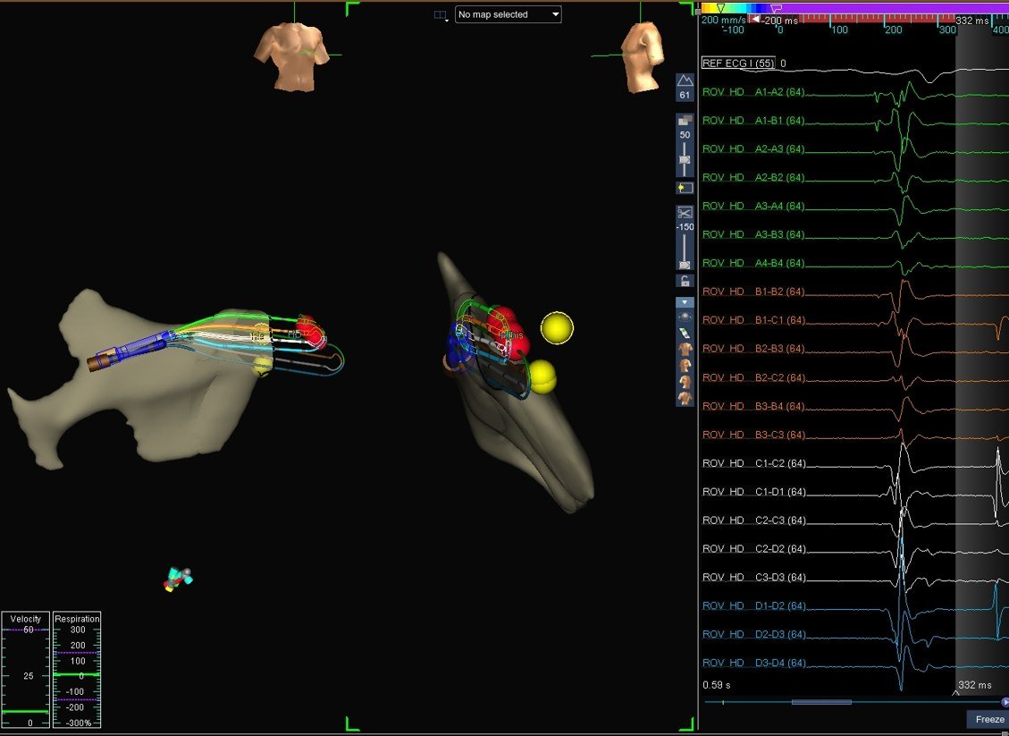 3D electroanatomical map with the His bundle region tagged, beside the multi-electrode electrograms
