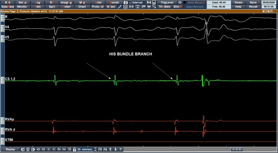 Intracardiac electrogram with the His bundle potential marked, with surface leads III, V4 and V5