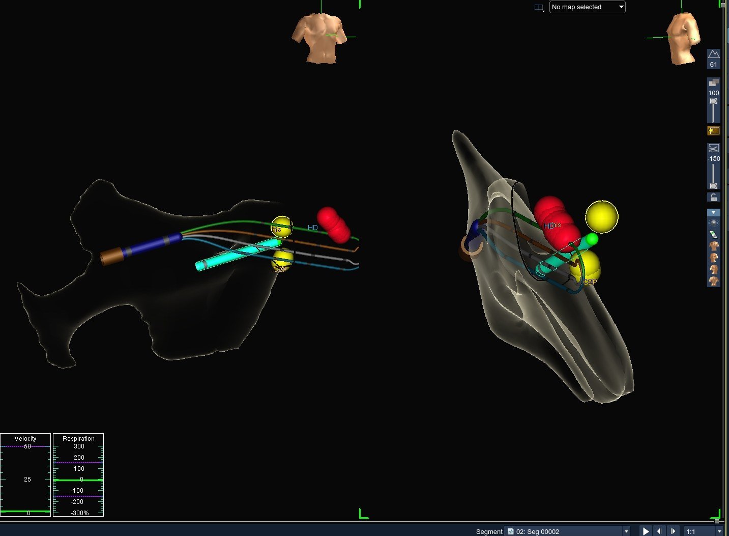 3D map showing the pacing lead in green advancing to the tagged conduction system pacing site