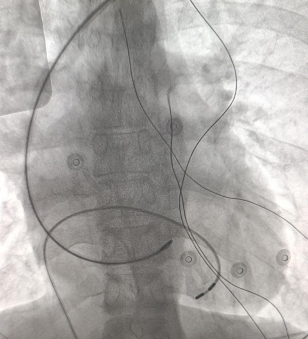 Fluoroscopy of the pacing lead being delivered through its sheath to the conduction system site