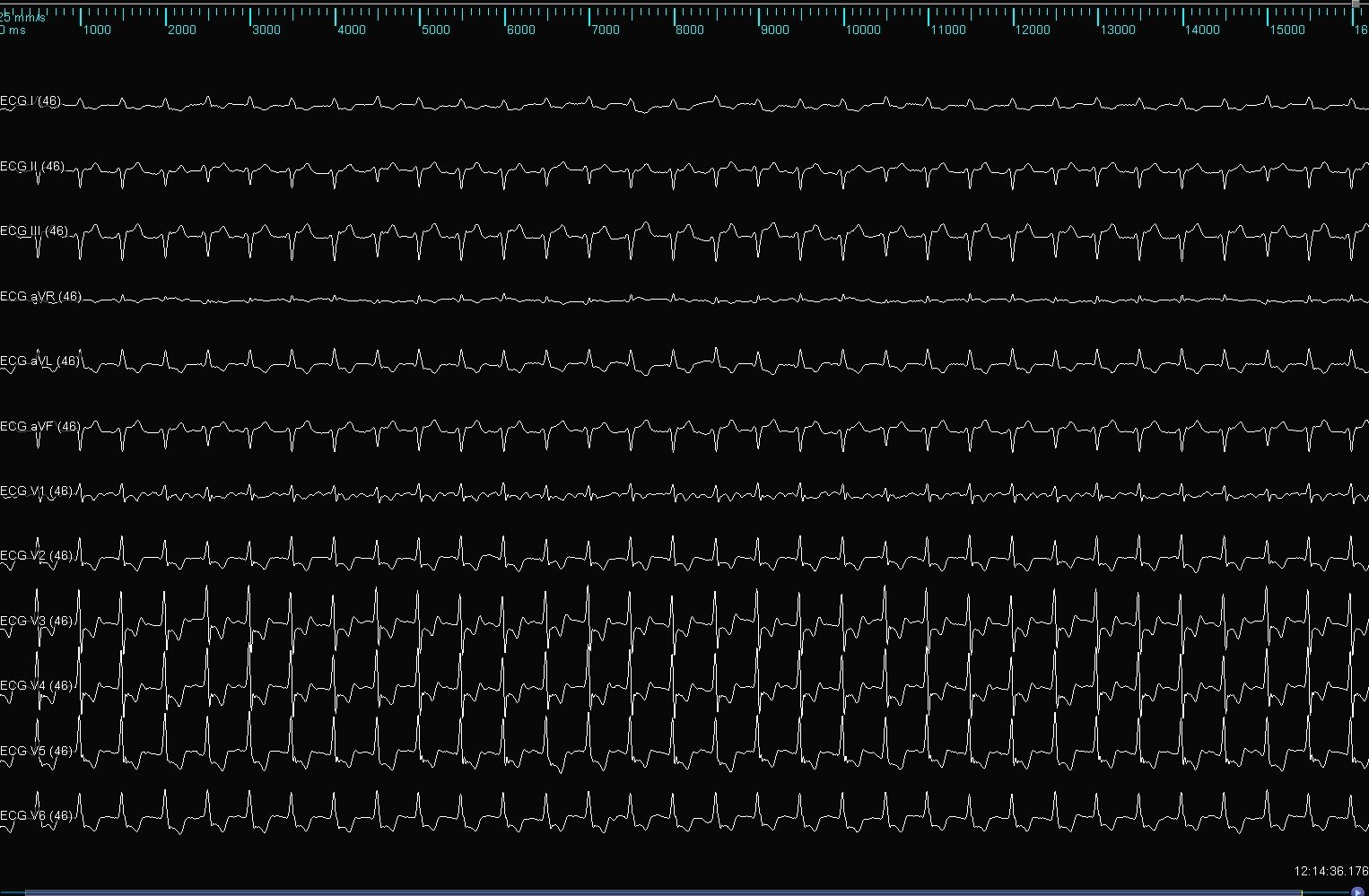 12-lead ECG after radiofrequency ablation showing regular paced rhythm with QRS 123 ms