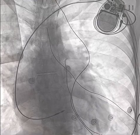 Final fluoroscopic image showing the pulse generator in the left chest and the lead course to the heart
