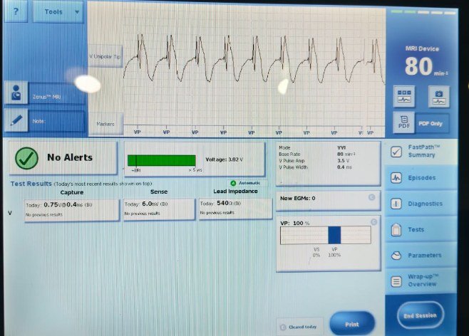 Pacemaker programmer screen at implant: VVI 80, capture 0.75 V at 0.4 ms, sensing 6.0 mV, impedance 540 ohms