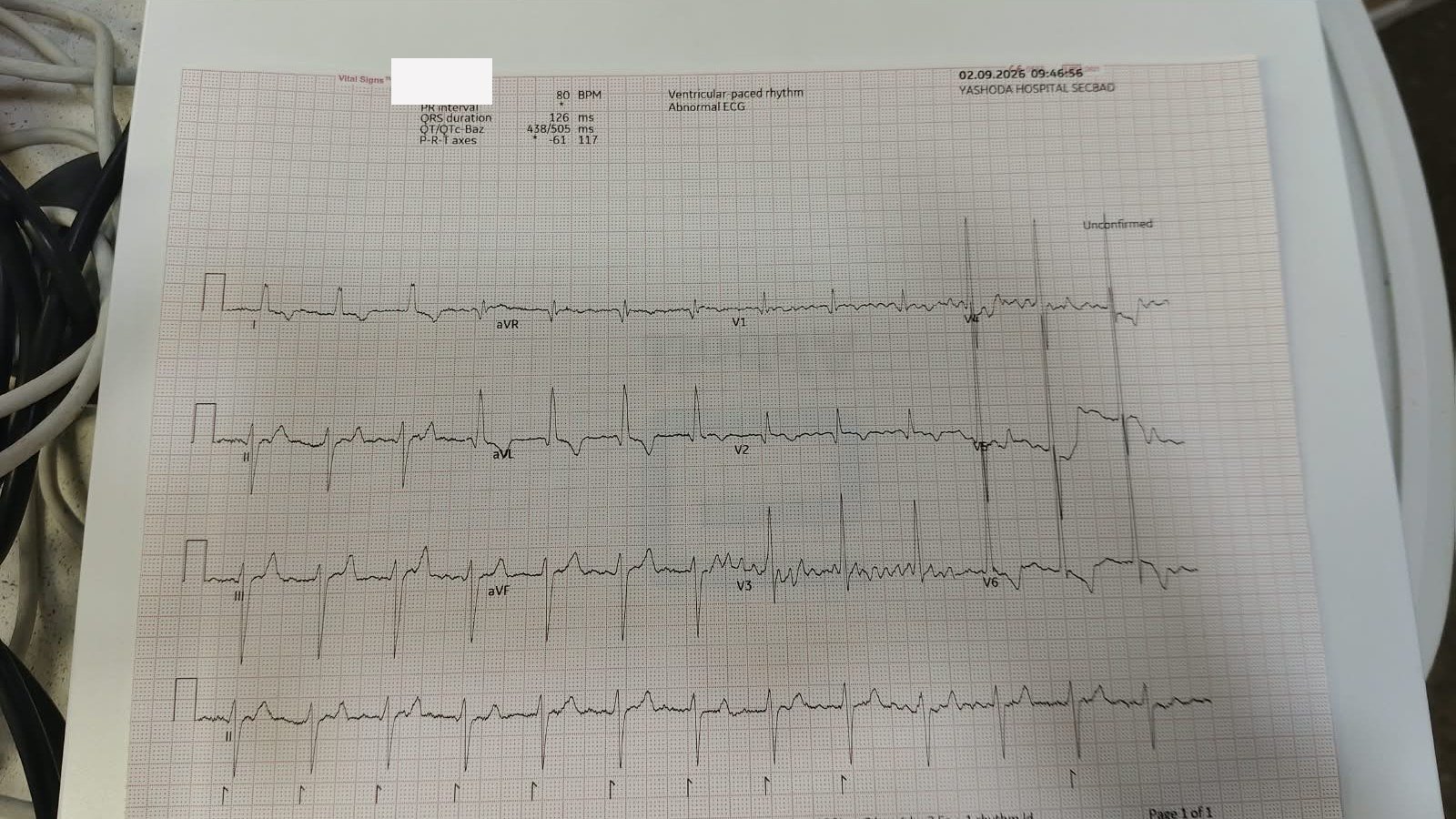 Day-one 12-lead ECG after conduction system pacing: ventricular paced rhythm at 80/min, QRS 126 ms