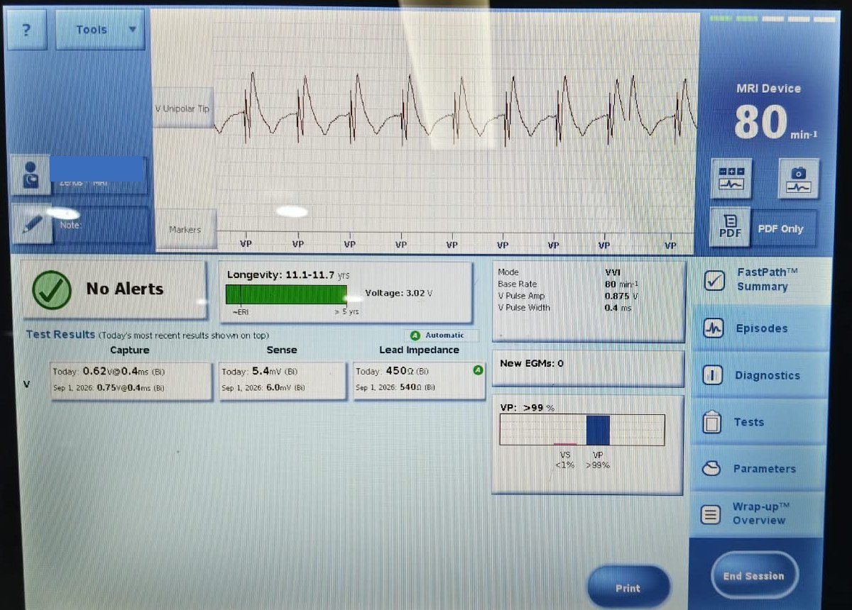 Pacemaker programmer screen on day one: capture 0.62 V at 0.4 ms, sensing 5.4 mV, impedance 450 ohms, ventricular pacing over 99%